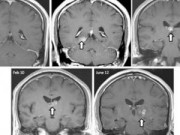 Tin tức - Sốc: Sán dây dài 5cm sống trong não người 4 năm