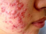Làm đẹp - Những hệ lụy khó lường từ mốt lột da