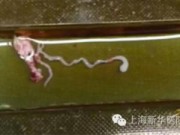Tin tức - Sán dài 8cm làm tổ trong não bé trai 11 tuổi