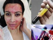 Làm đẹp - Bủn rủn với mốt trẻ hóa, căng da mặt bằng... máu