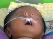 Tin tức - Bệnh hiếm gặp: Em bé sinh ra với hai mũi tách biệt