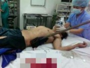 Tin tức - Sập giàn giáo, bị cây sắt dài hơn 1 mét đâm xuyên người
