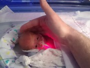 Bà bầu - Bé sinh non 0,5kg sống sót thần kỳ nhờ một chiếc túi nhựa