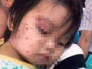 Tin tức - Cháu bé bị nhiều vết thương ở mặt là do bị bạn cào, cấu