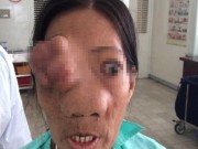 Tin tức - Phẫu thuật lấy khối u khổng lồ lan từ mũi đến sọ não
