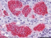 Sức khỏe - “Sốc” với phát hiện ung thư có thể lây qua sán dây