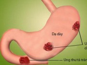Tin tức - Ăn mặn có thể làm tăng nguy cơ mắc ung thư dạ dày