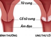 Tin tức - Phụ nữ trình độ cao, nguy cơ ung thư cổ tử cung lớn