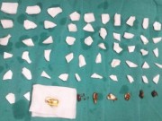 Tin tức - Gắp 59 mảnh chén vỡ trong bụng bệnh nhân