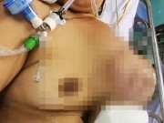 Tin tức - Mang khối u xương ngực nguy hiểm từ nốt mụn nhỏ