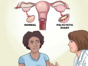 Eva Yêu - Cách nhận biết bệnh buồng trứng đa nang