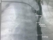 Tin tức - Nong eo động mạch chủ cứu sống bệnh nhi 2,5 tháng tuổi