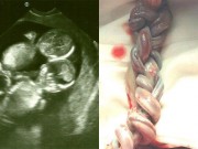 Bà bầu - Hai dây rốn đan nhau như tết tóc, cặp song sinh vẫn sống sót kỳ diệu