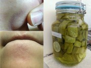 Làm đẹp - Bí kíp diệt sạch mụn ẩn, mụn li ti chỉ trong 1 nốt nhạc