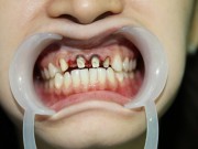 Sức khỏe - Đừng coi thường những đau nhức răng thoáng qua
