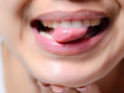 Tin tức - Giật mình tưởng bị nhiệt miệng hóa ra mắc ung thư lưỡi