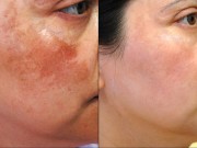 Làm đẹp - Ăn nhiều món này mỗi ngày nám và mụn sẽ sớm rời bỏ bạn