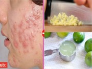 Làm đẹp - Mụn mủ, mụn bọc sưng viêm đến mấy cũng sẽ xẹp ngay sau một đêm