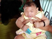 Tin tức - Việt Nam lần đầu phát hiện bé gái nghi mắc dị tật đầu nhỏ do Zika