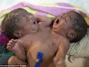 Tin tức - Song sinh dính liền có 4 tay, 2 chân bị bố mẹ bỏ rơi trong bệnh viện