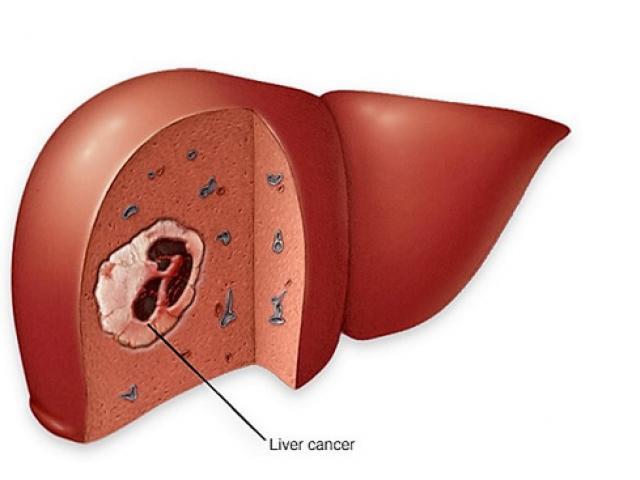 Người béo phì, đái tháo đường đề phòng ung thư gan