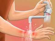 Tin tức - Chuyên gia hướng dẫn cách sơ cứu đơn giản, hiệu quả khi trẻ bị bỏng
