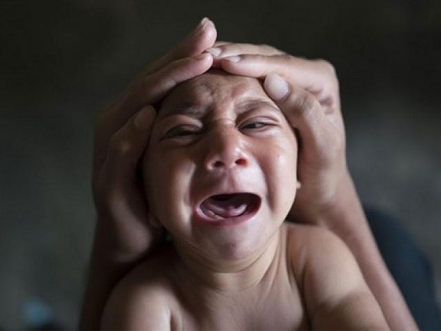 Thông tin mới nhất về hai bé mắc dị tật đầu nhỏ nghi do virus Zika