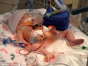 Bà bầu - Hình ảnh khó tin của em bé sinh ra với nội tạng nằm ngoài cơ thể