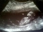 Bà bầu - Bức ảnh siêu âm bụng sau sảy thai khiến bà mẹ "sững người"