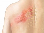 Sức khỏe - Cách phân biệt vết zona thần kinh, "giời leo" và kiến 3 khoang cắn