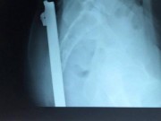 Tin tức - Nữ sinh 16 tuổi bị thanh sắt trên xe ba bánh đâm xuyên người