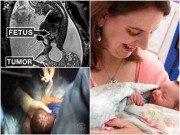 Bà bầu - 3 lần lấy thai nhi ra ngoài phẫu thuật rồi lại đưa vào cơ thể mẹ gây kinh ngạc