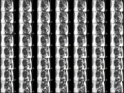 Tin tức - Thấy bụng to lên, người phụ nữ đi khám bất ngờ phát hiện 30 khối u chi chít trong tử cung