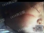 Tin tức - TQ: Mẹ sinh mổ, em bé vừa sinh ra đã bị rách mặt bởi sự bất cẩn của bác sĩ
