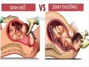 Bà bầu - 7 bí mật về sinh mổ mà ít ai nói cho mẹ bầu biết