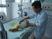 Tin tức - Xót xa cháu bé 17 tháng tuổi ngã vào nồi canh bị bỏng toàn thân