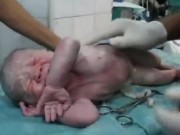 Clip Eva - Khoảnh khắc hồi sinh em bé tim ngừng đập trong bụng mẹ