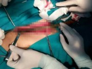 Tin tức - Hoảng hồn bé trai bị cành nhãn dài 25 cm đâm xuyên 'của quý'