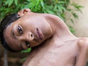 Tin tức - Cậu bé có đầu nghiêng 180 độ qua đời sau 8 tháng làm phẫu thuật