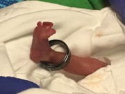 Bà bầu - Em bé sinh non với bàn chân lọt thỏm trong chiếc nhẫn của bố