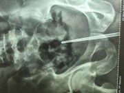 Tin tức - Chàng trai TQ bị mắc kẹt chiếc đũa dài trong "của quý" khi tự khám bệnh