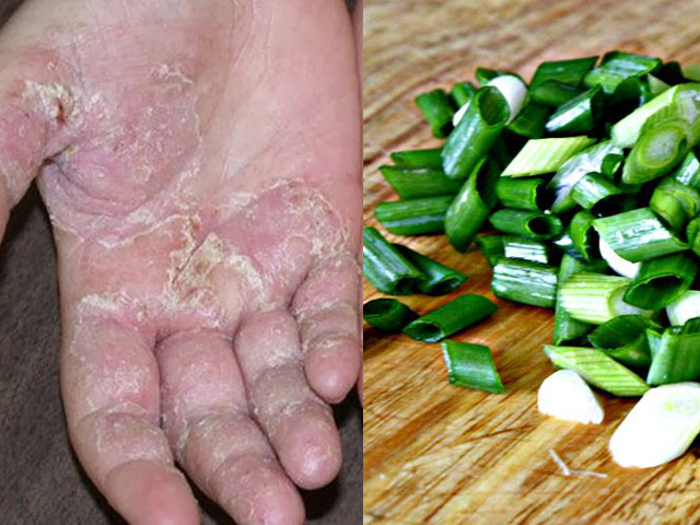 Thổi bay viêm da cơ địa, vảy nến, á sừng lâu năm nhờ loại cây nhỏ nhưng có võ