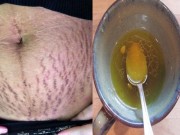 Làm đẹp - Rạn trắng, rạn đỏ trên da sẽ mờ dần mỗi ngày nhờ hỗn hợp dưới đây