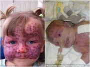 Làm mẹ - Khuôn mặt khác lạ sau phẫu thuật của bé gái bị chàm trên mặt