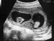 Bà bầu - Bí ẩn chuyện thụ thai cả thế giới mới có 10 ca khiến nhiều người nghi ngờ