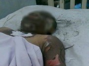 Tin tức - Bật bếp nấu cháo dinh dưỡng, người phụ nữ biến dạng mặt, hai tay cháy đen vì bỏng