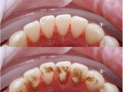 Làm đẹp - 4 cách làm trắng răng từ 1 quả chanh không phải ai cũng biết