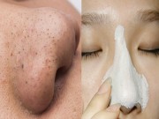 Làm đẹp - Áp dụng 1 trong 9 cách sau, mụn đầu đen chỉ có nước "một đi không trở lại"