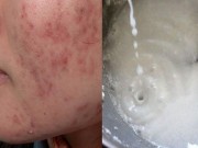 Làm đẹp - Trộn nước dừa và mật ong rồi thoa lên mặt, sẹo và vết thâm sẽ dần dần mất hết