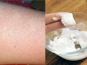 Làm đẹp - Chặn đứng viêm nang lông vĩnh viễn bằng những cách  đơn giản không ngờ